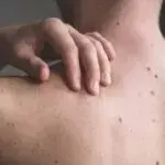 Невус фавн-хвост