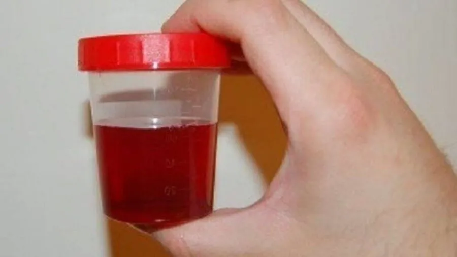 Чому змінюється колір сечі і про що це говорить